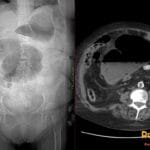 Abdominal radiograph and axial CT showing cecal volvulus with dilated displaced cecum in left upper quadrant and whirl sign.