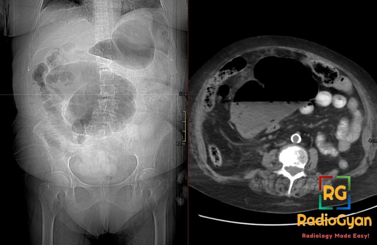 Abdominal radiograph and axial CT showing cecal volvulus with dilated displaced cecum in left upper quadrant and whirl sign.