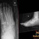 Right foot radiographs showing divergent Lisfranc fracture-dislocation with 1st-2nd intermetatarsal widening