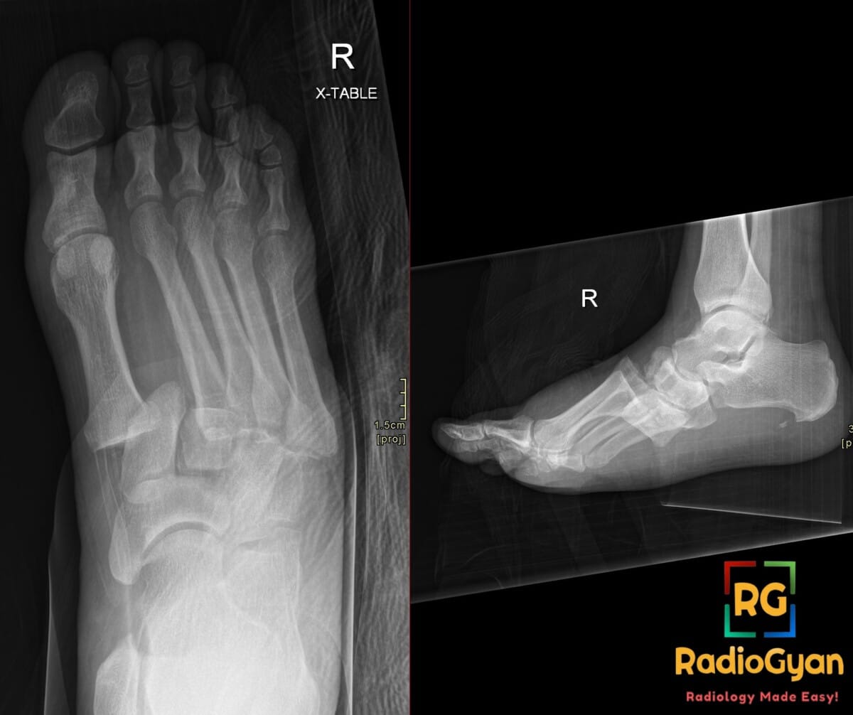 Right foot radiographs showing divergent Lisfranc fracture-dislocation with 1st-2nd intermetatarsal widening
