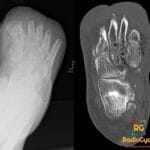 Foot X-ray and CT showing emphysematous osteomyelitis with intraosseous and soft tissue gas locules, post amputation