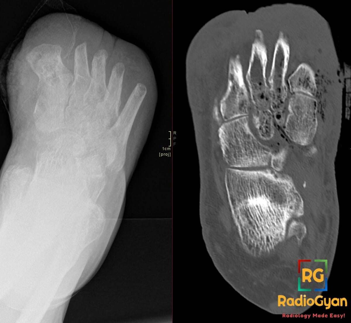 Foot X-ray and CT showing emphysematous osteomyelitis with intraosseous and soft tissue gas locules, post amputation