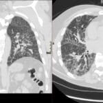 HRCT chest showing fibrotic hypersensitivity pneumonitis with ground-glass opacities, reticulation, and traction bronchiectasis