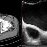 CT and ultrasound images showing Hutch diverticulum of bladder near right UVJ