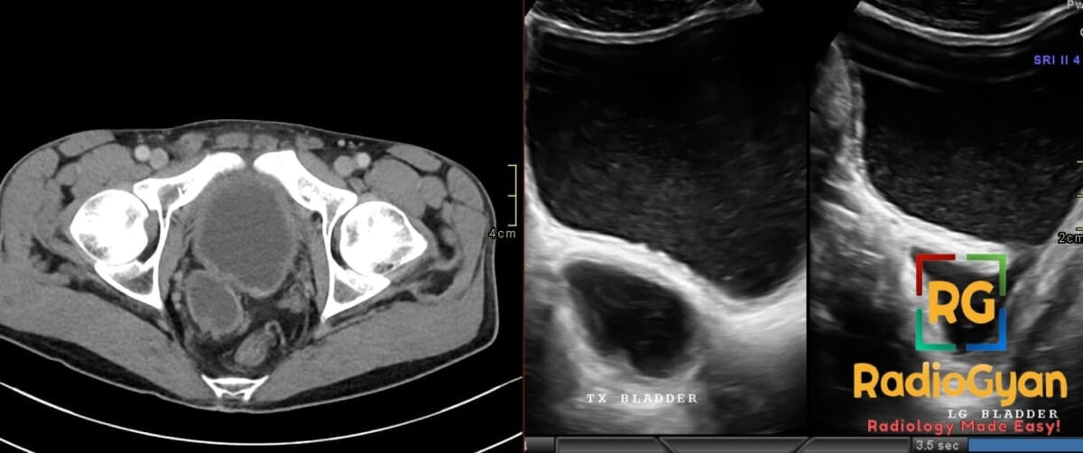 CT and ultrasound images showing Hutch diverticulum of bladder near right UVJ