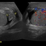 Transverse scrotal ultrasound with color Doppler showing enlarged left epididymis with hyperemia from epididymo-orchitis