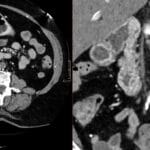 CT angiography showing calcified occlusion of the distal abdominal aorta and iliac arteries in Leriche syndrome