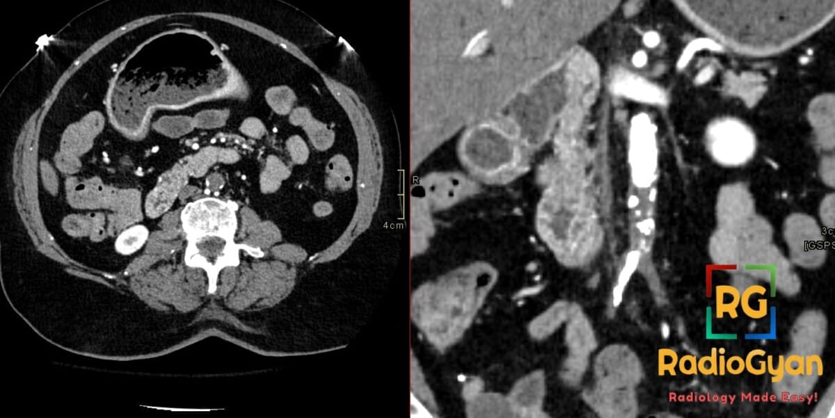 CT angiography showing calcified occlusion of the distal abdominal aorta and iliac arteries in Leriche syndrome