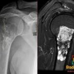 X-ray and MRI of proximal humerus showing low-grade chondrosarcoma lesion over 5 cm with endosteal scalloping
