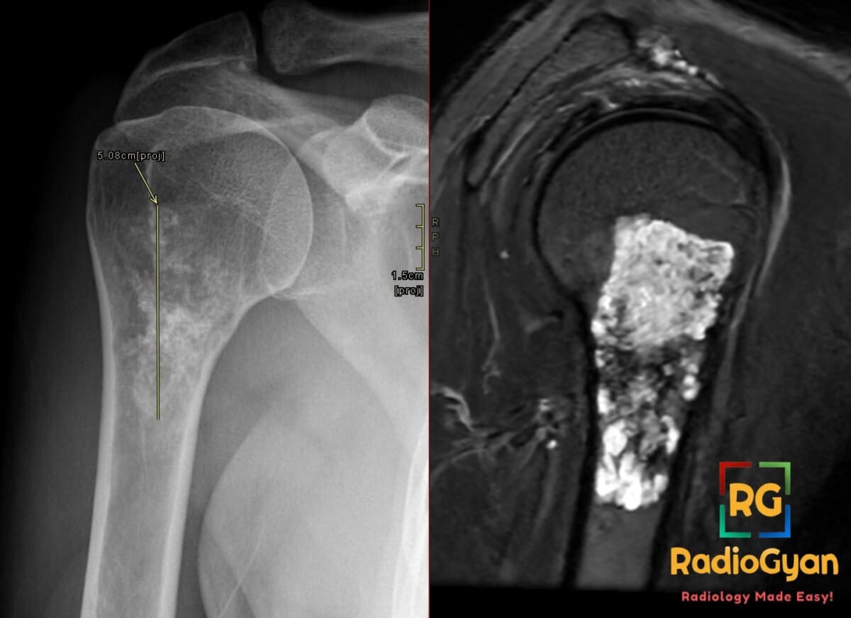 X-ray and MRI of proximal humerus showing low-grade chondrosarcoma lesion over 5 cm with endosteal scalloping