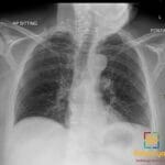 Chest X-ray showing a misplaced right PICC catheter with its tip directed cephalad into the right internal jugular vein instead of the SVC.