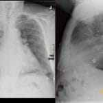 Chest X-ray PA and lateral views showing a MitraClip device positioned at the mitral valve for transcatheter edge-to-edge repair.