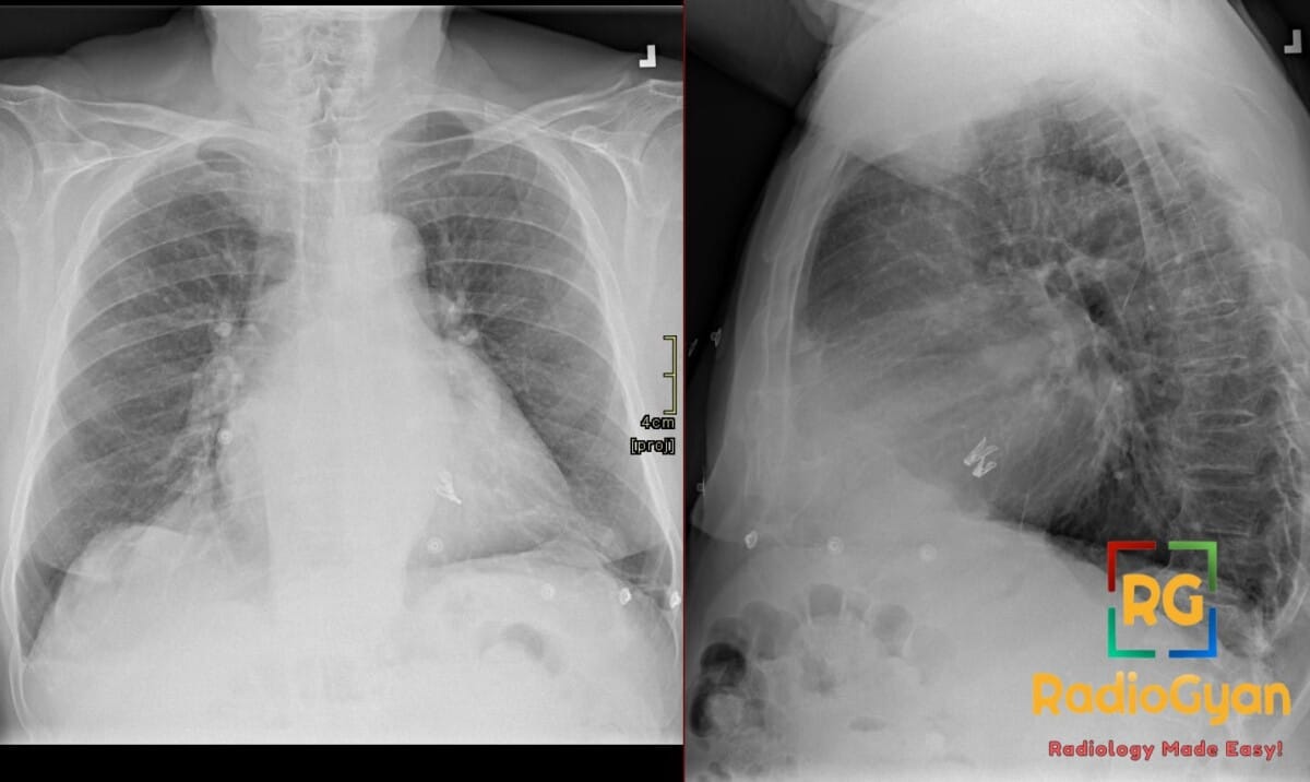 Chest X-ray PA and lateral views showing a MitraClip device positioned at the mitral valve for transcatheter edge-to-edge repair.