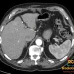 Axial contrast-enhanced CT showing a replaced left hepatic artery coursing through the fissure for ligamentum venosum