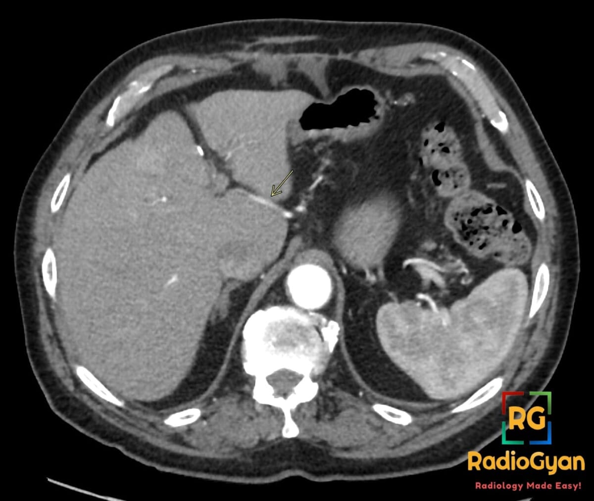 Axial contrast-enhanced CT showing a replaced left hepatic artery coursing through the fissure for ligamentum venosum