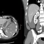 CT abdomen showing shattered spleen with hemoperitoneum and subcutaneous emphysema along left chest wall