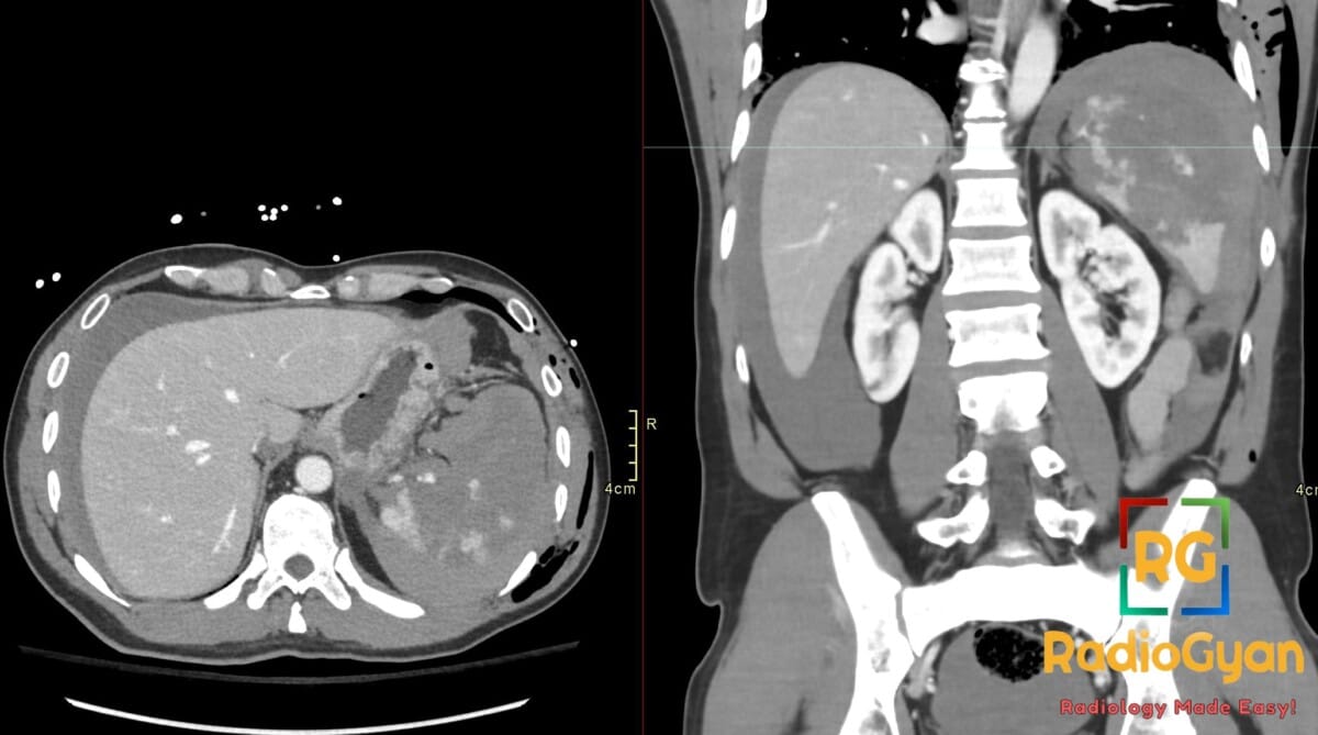 CT abdomen showing shattered spleen with hemoperitoneum and subcutaneous emphysema along left chest wall