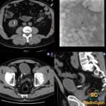 CT scan showing steinstrasse with a column of stone fragments in the right lower ureter post-lithotripsy