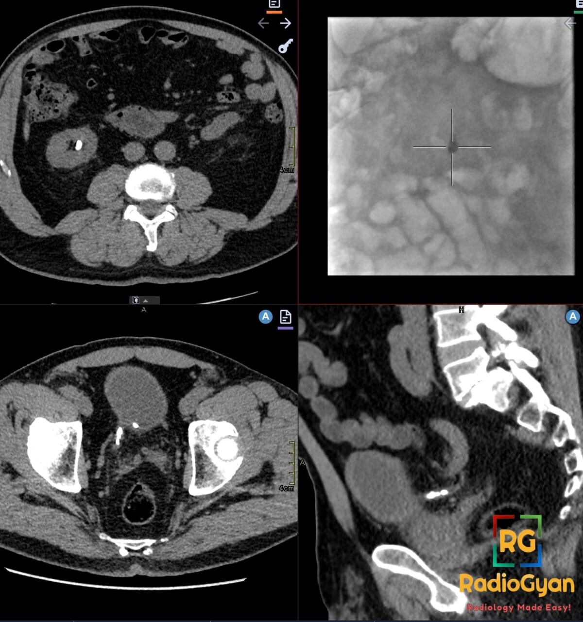 CT scan showing steinstrasse with a column of stone fragments in the right lower ureter post-lithotripsy