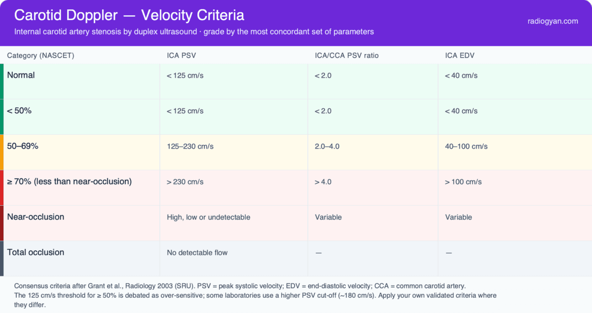 Carotid Doppler ultrasound velocity criteria — ICA peak systolic velocity, ICA/CCA ratio and end-diastolic velocity for each NASCET stenosis category