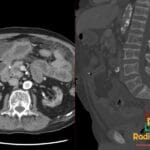 Lumbar spine CT bone window showing renal osteodystrophy with calcifications in a hemodialysis patient with acquired cystic kidney disease