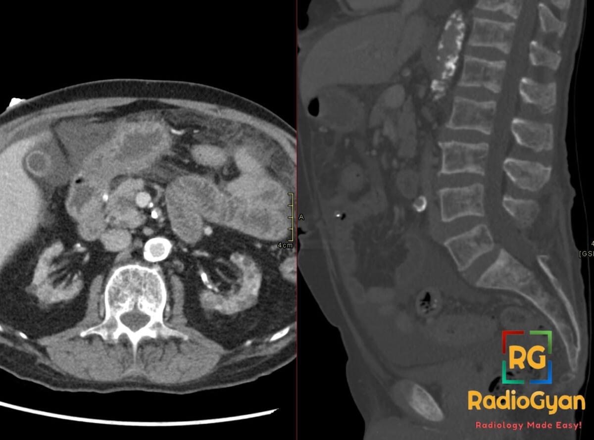 Lumbar spine CT bone window showing renal osteodystrophy with calcifications in a hemodialysis patient with acquired cystic kidney disease