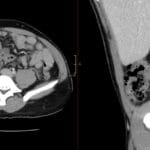 Axial and sagittal CT images of the abdomen showing ascending colon diverticulitis with pericolonic stranding