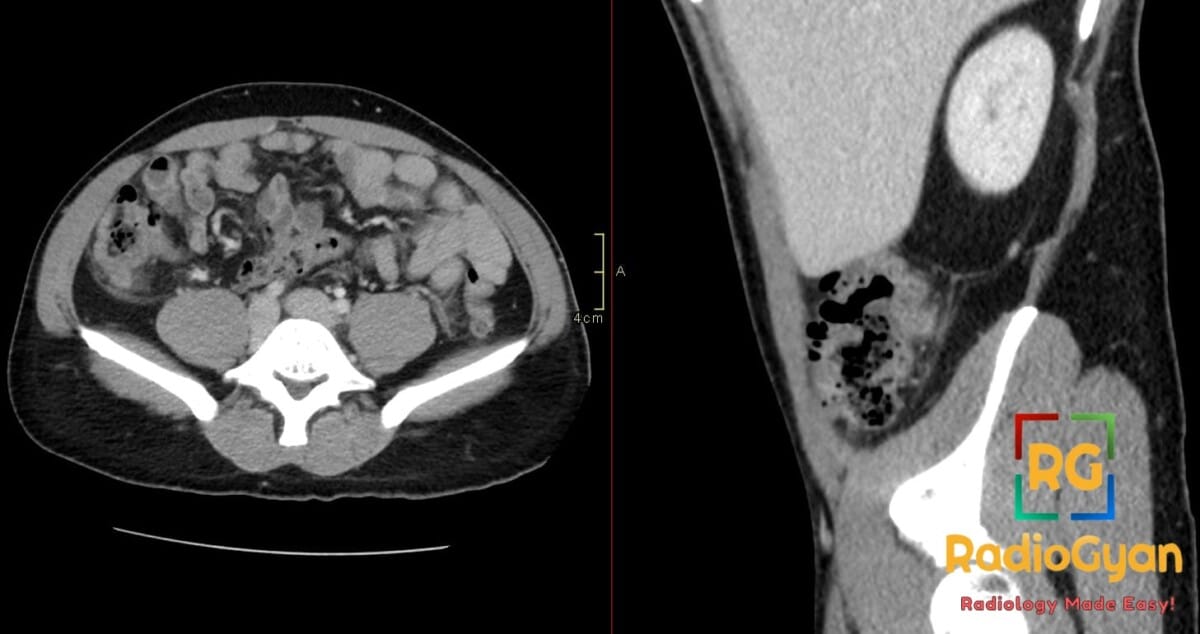 Axial and sagittal CT images of the abdomen showing ascending colon diverticulitis with pericolonic stranding
