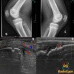 Bilateral knee imaging showing Sinding-Larsen-Johansson with inferior patellar irregularity and patellar tendon hyperemia