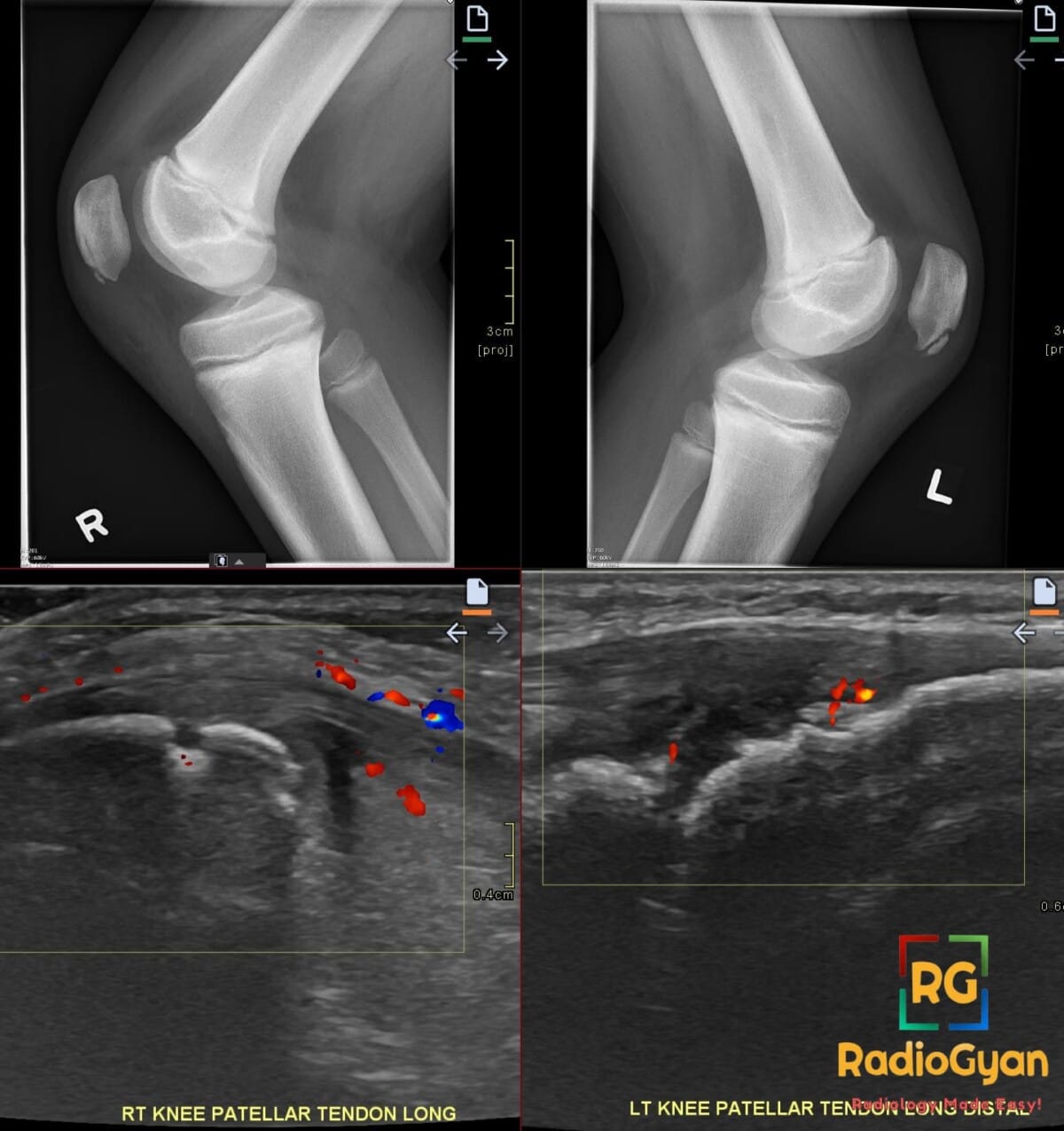 Bilateral knee imaging showing Sinding-Larsen-Johansson with inferior patellar irregularity and patellar tendon hyperemia