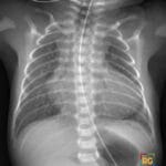 Pediatric chest X-ray showing the classic boot-shaped heart (coeur en sabot) of Tetralogy of Fallot with upturned apex