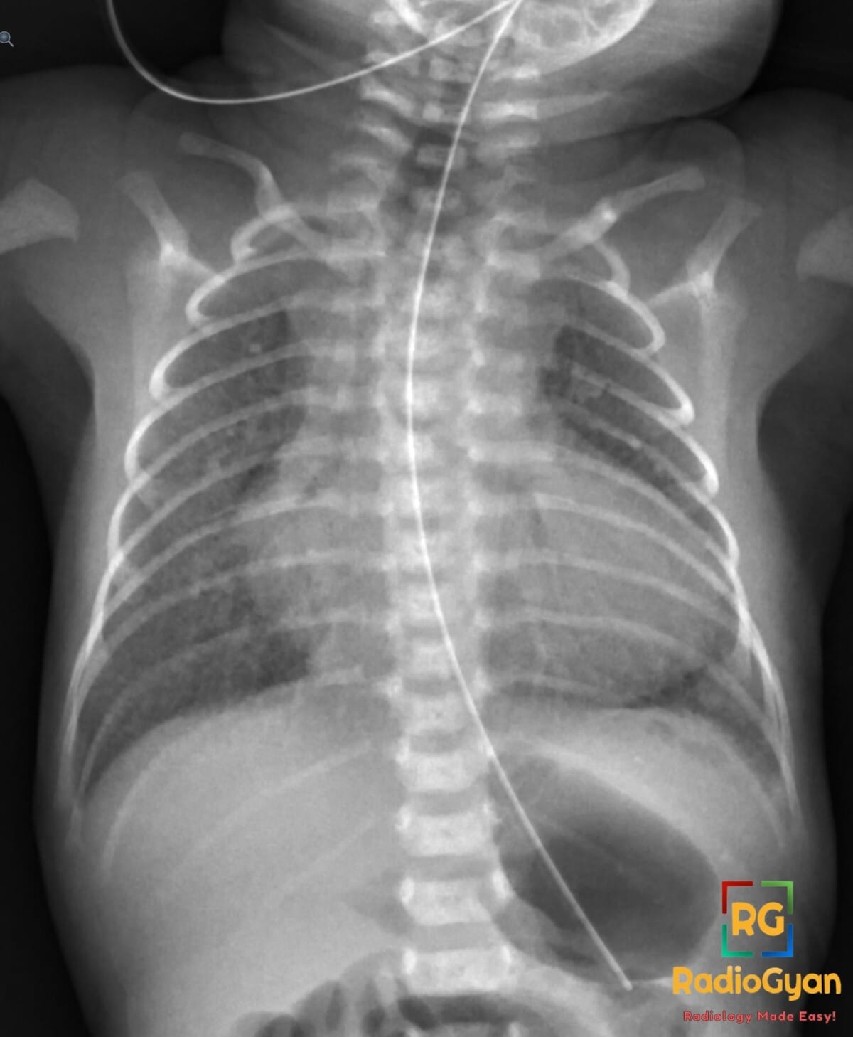 Pediatric chest X-ray showing the classic boot-shaped heart (coeur en sabot) of Tetralogy of Fallot with upturned apex