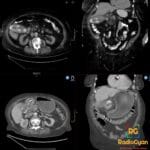 CT showing Bouveret syndrome: prior gallbladder calculi and gastric outlet obstruction by fistulizing gallstone