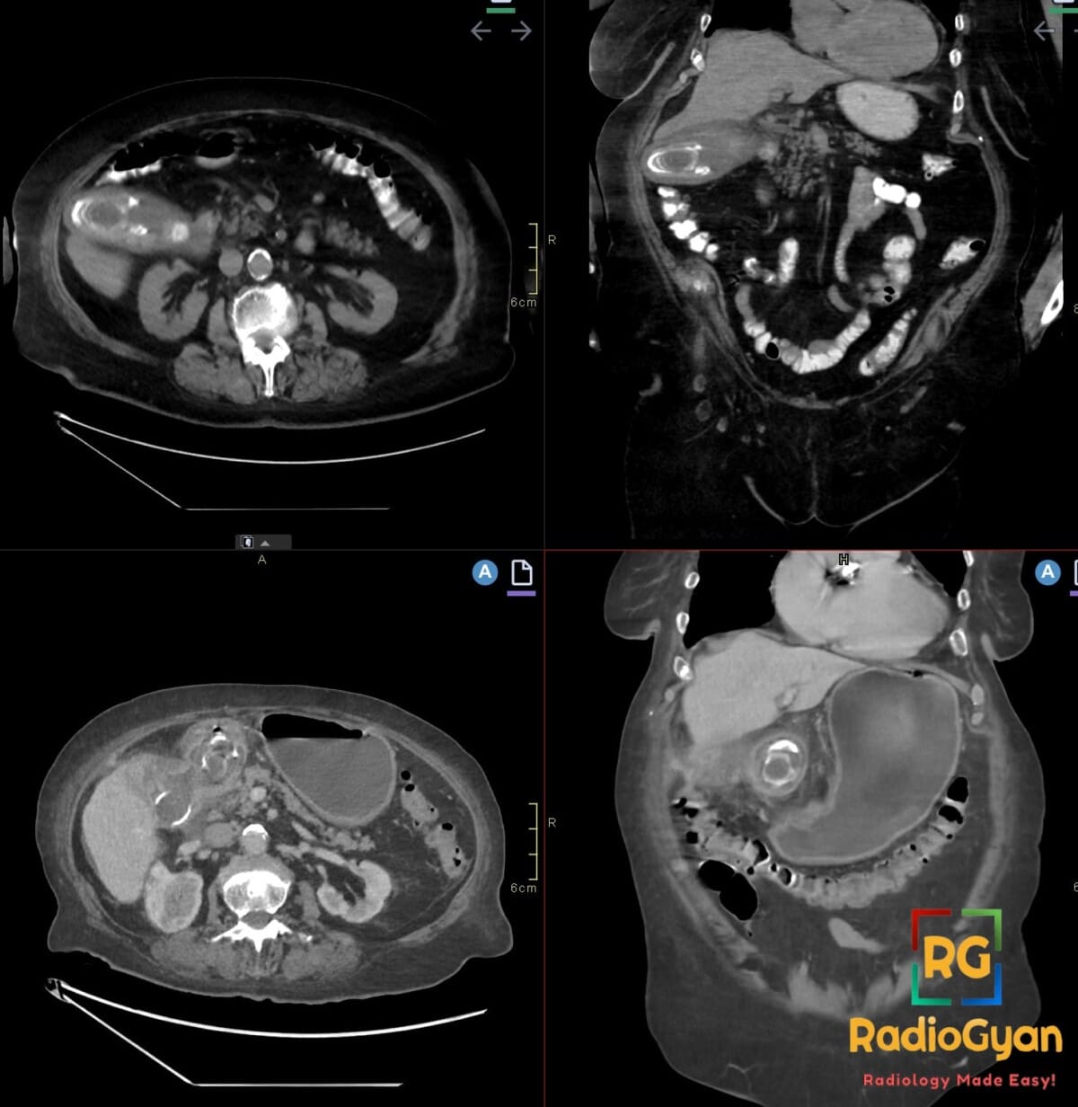 CT showing Bouveret syndrome: prior gallbladder calculi and gastric outlet obstruction by fistulizing gallstone