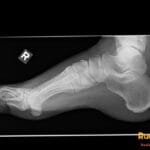 Lateral foot X-ray showing a dorsal avulsion fracture of the navicular bone in the right foot
