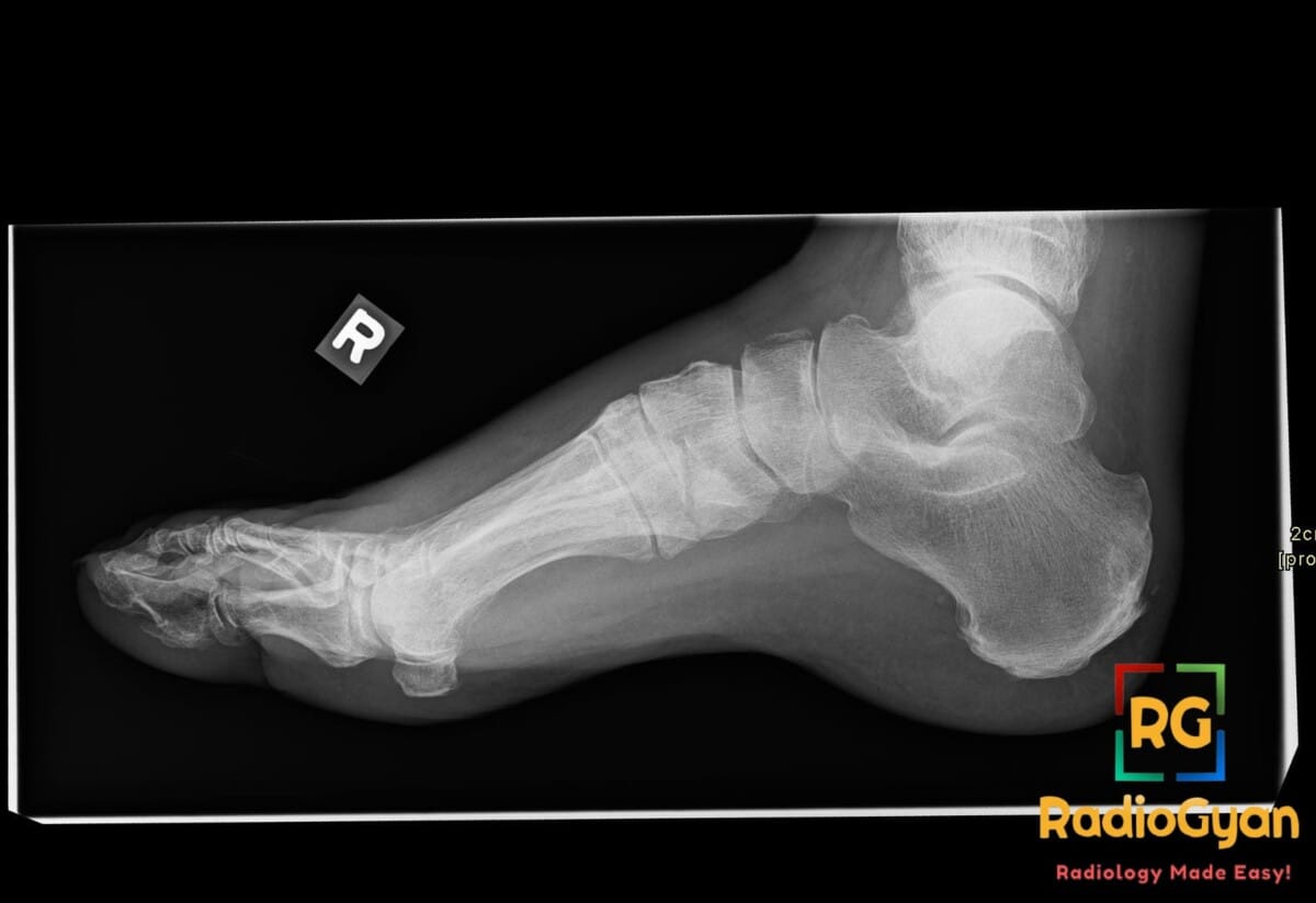 Lateral foot X-ray showing a dorsal avulsion fracture of the navicular bone in the right foot