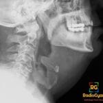 Lateral neck radiograph showing a swollen epiglottis with the classic thumb sign of epiglottitis