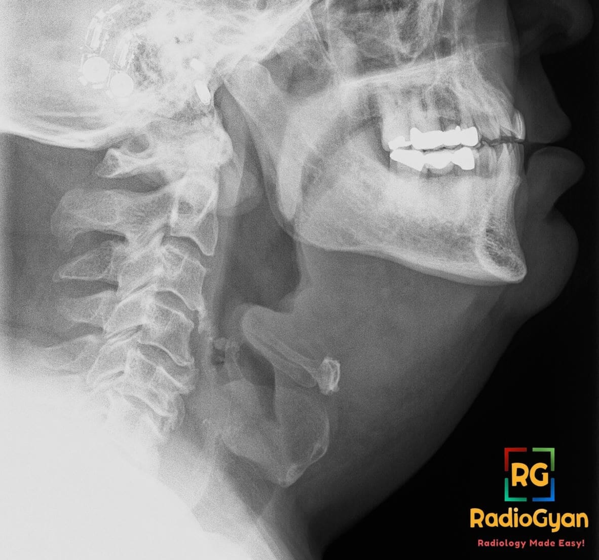 Lateral neck radiograph showing a swollen epiglottis with the classic thumb sign of epiglottitis