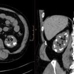 Axial and coronal non-contrast CT images of the abdomen showing extensive bilateral medullary nephrocalcinosis with dense calcifications in both renal pyramids