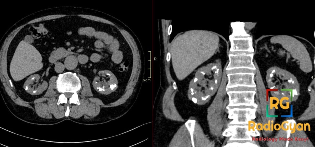 Axial and coronal non-contrast CT images of the abdomen showing extensive bilateral medullary nephrocalcinosis with dense calcifications in both renal pyramids