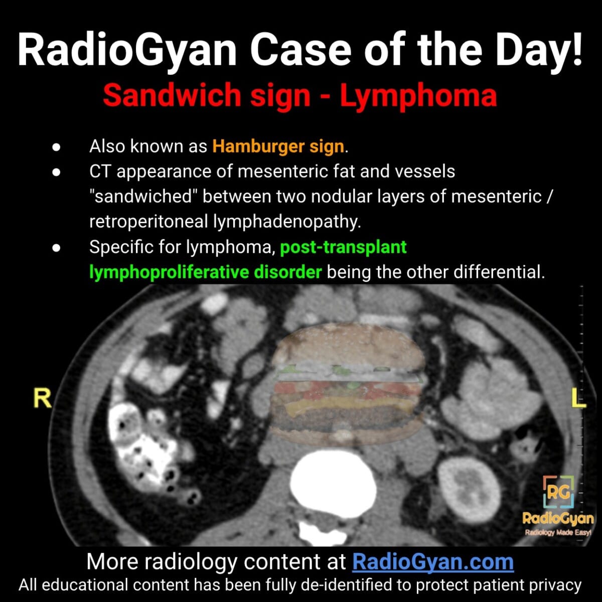 Axial abdominal CT showing the hamburger sandwich sign with mesenteric lymphadenopathy in lymphoma