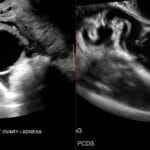 Transvaginal ultrasound of right adnexa showing hydrosalpinx with cog-wheel sign and retort-shaped tubular cystic dilation