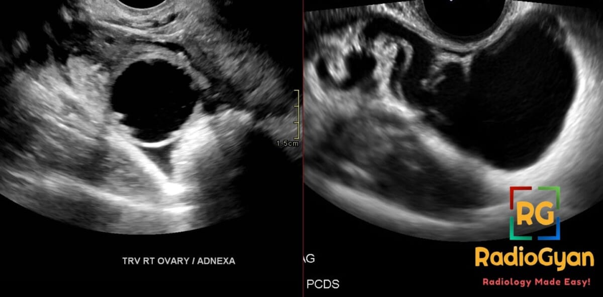 Transvaginal ultrasound of right adnexa showing hydrosalpinx with cog-wheel sign and retort-shaped tubular cystic dilation
