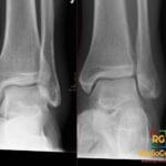 Ankle radiograph showing a subtle lateral talar process avulsion fracture with linear lucency, known as a snowboarder fracture