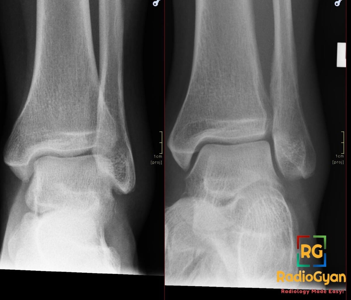Ankle radiograph showing a subtle lateral talar process avulsion fracture with linear lucency, known as a snowboarder fracture