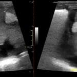 Neonatal liver ultrasound showing TPNomas from umbilical venous catheter extravasation in segments 2 and 4A
