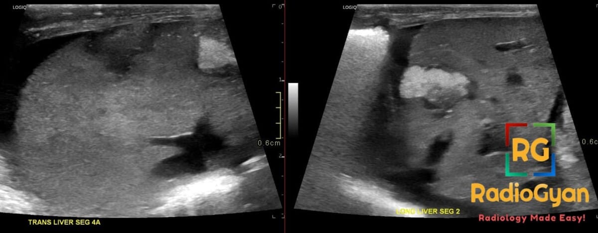 Neonatal liver ultrasound showing TPNomas from umbilical venous catheter extravasation in segments 2 and 4A