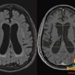 Axial brain MRI demonstrating ventriculomegaly with elevated Evans Index of 0.37, consistent with normal pressure hydrocephalus