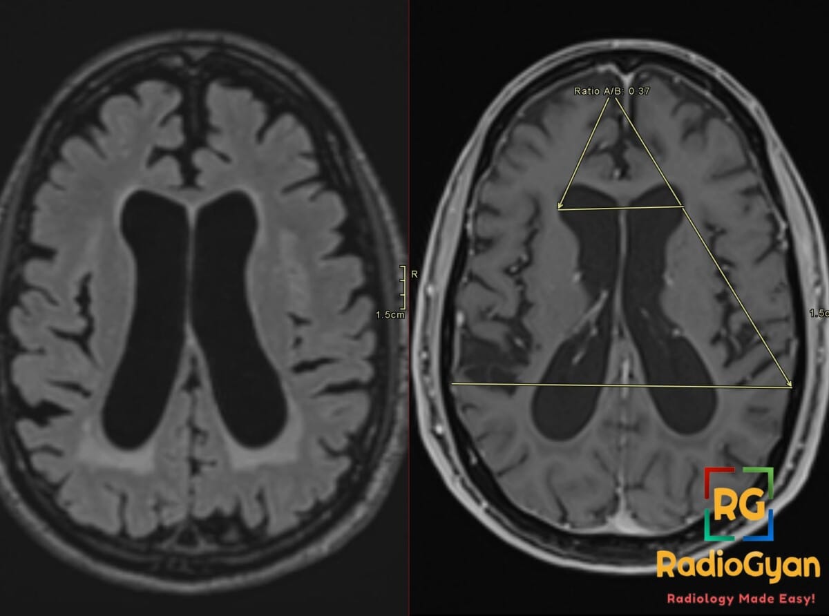 Axial brain MRI demonstrating ventriculomegaly with elevated Evans Index of 0.37, consistent with normal pressure hydrocephalus