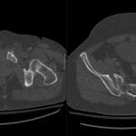 Axial CT pelvis showing pubic symphysis diastasis and right sacroiliac joint widening after MVC trauma